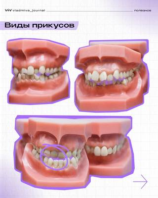 Физиологический и патологический прикус — ключевые различия.